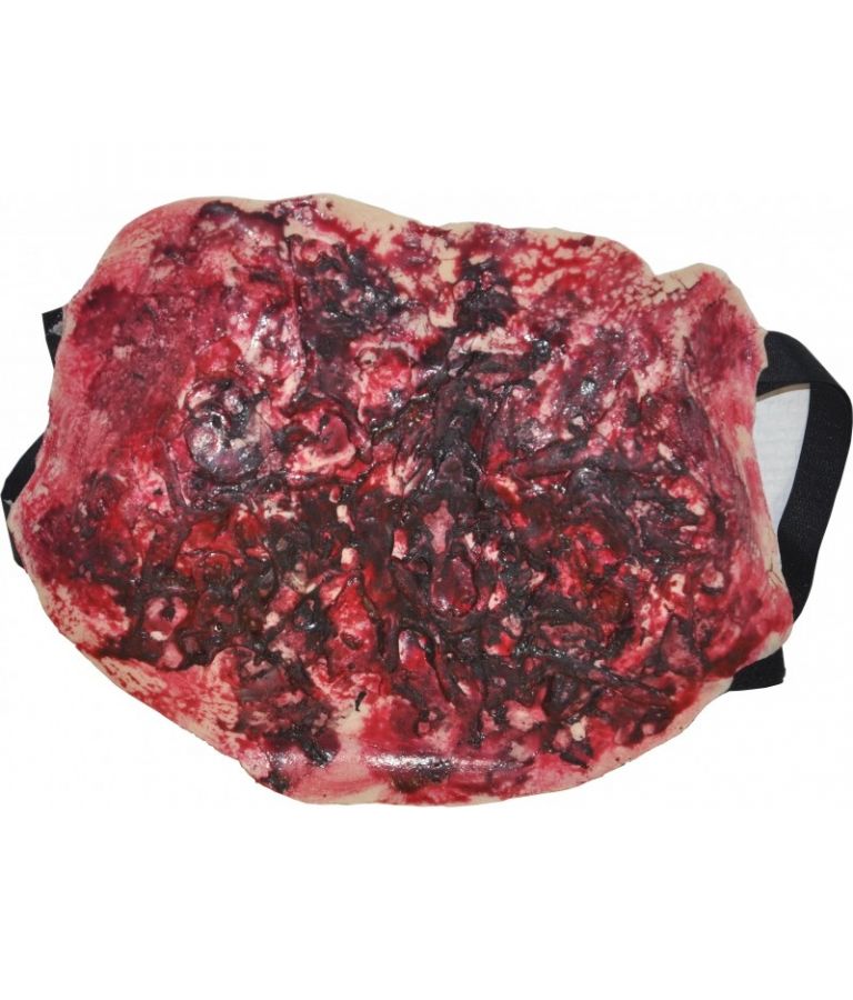 Brûlure thermique thorax